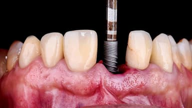 Lộ trình trồng răng Implant chuẩn y khoa