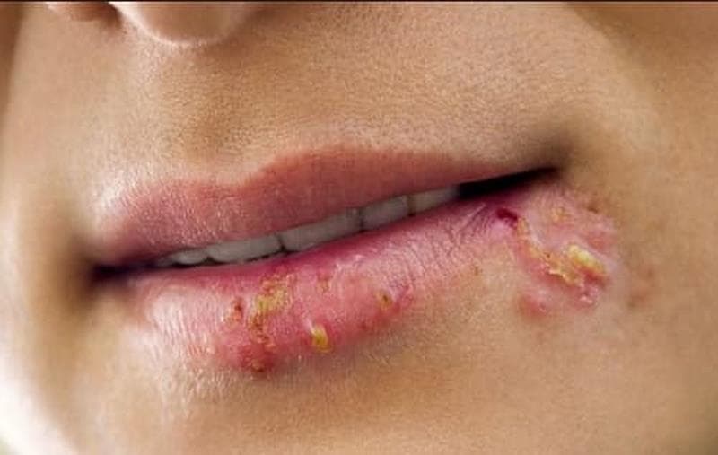 mụn rộp sinh dục trong miệng