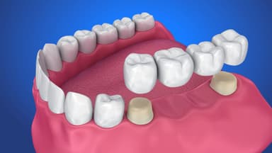 Mất chân răng có trồng răng sứ được không?
