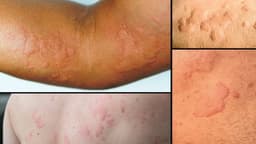 Nổi mề đay ở trẻ em phải làm sao?