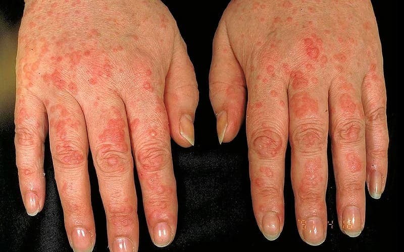 mề đay tái phát thường xuyên