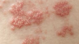 Bị mụn rộp sinh dục bao lâu thì khỏi?