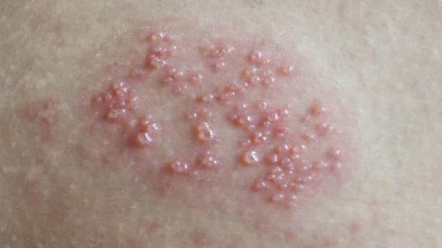 Mụn rộp sinh dục bao lâu thì phát bệnh?
