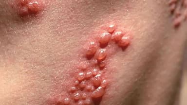 Bị mụn rộp sinh dục do đâu?
