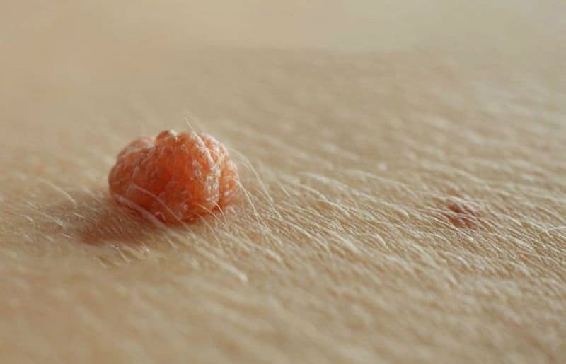 mụn rộp sinh dục nam có nguy hiểm không
