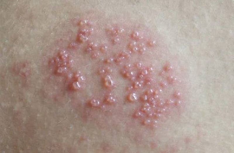 mụn rộp sinh dục do đâu