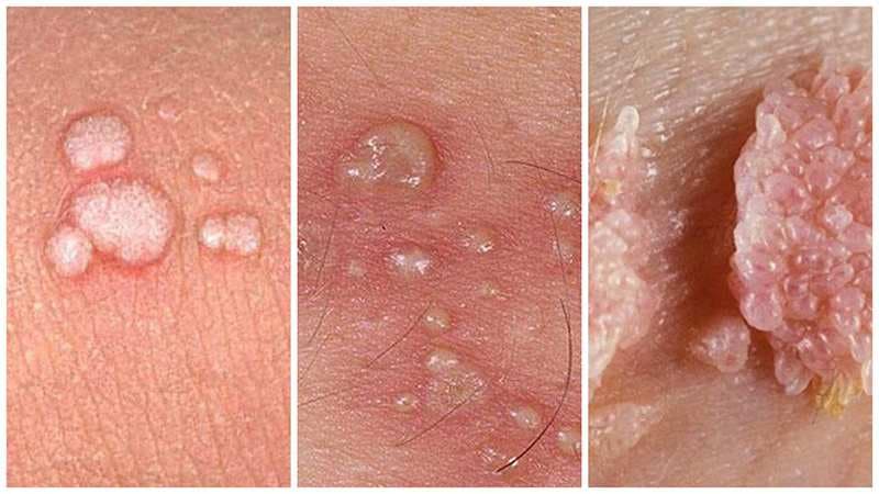 bị mụn rộp sinh dục phải làm sao