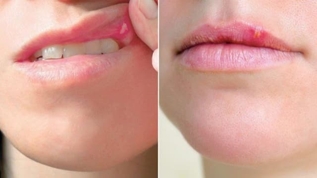 Mụn rộp sinh dục trong miệng