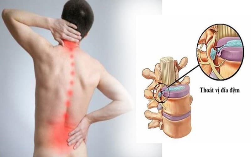 làm gì khi bị thoát vị đĩa đệm