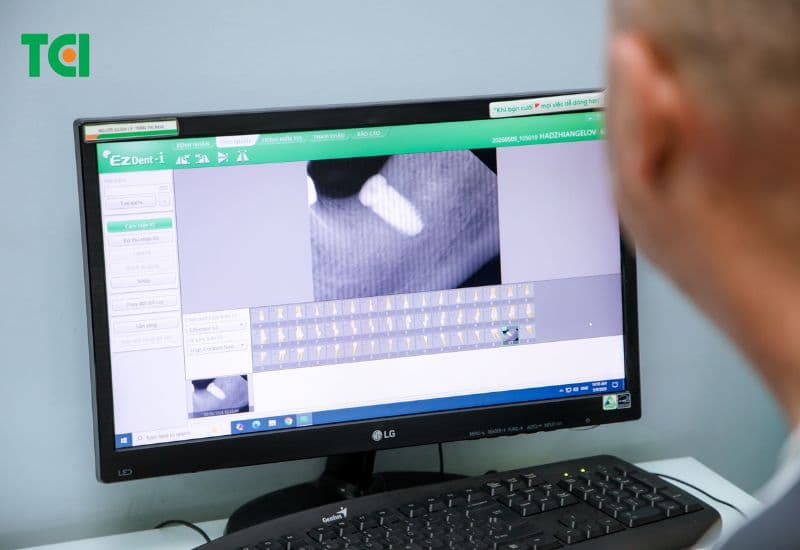nên làm răng bắc cầu hay implant