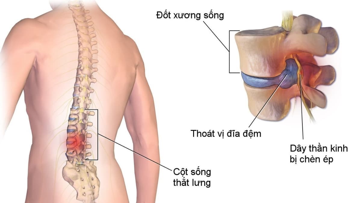 Nguyên nhân gây thoát vị đĩa đệm cột sống