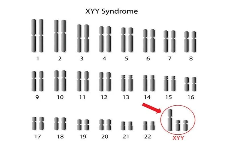hội chứng siêu nam có di truyền không