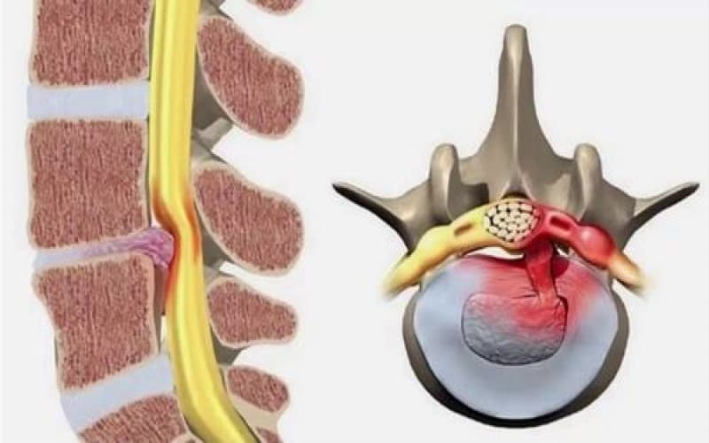 nguyên nhân gây thoát vị đĩa đệm cột sống