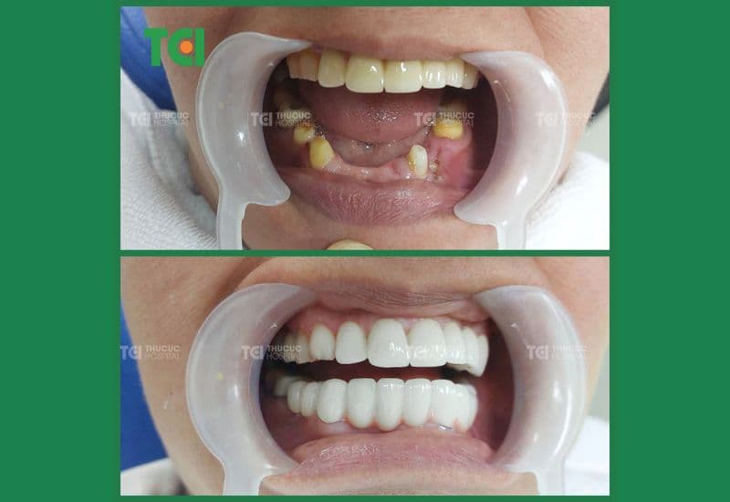 nhổ răng bao lâu thì làm cầu răng