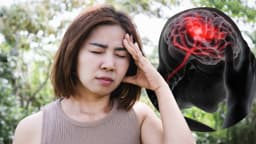 Nhồi máu não có phải là đột quỵ không?