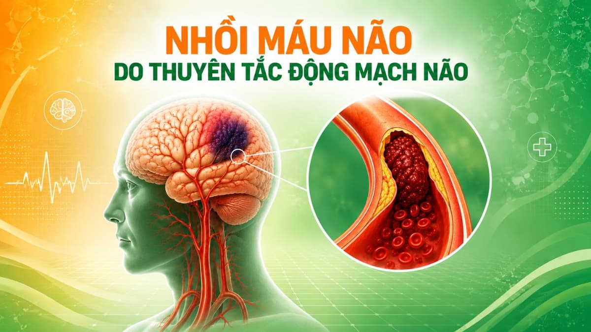 Tìm hiểu về nhồi máu não do thuyên tắc động mạch não