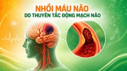 Tìm hiểu về nhồi máu não do thuyên tắc động mạch não
