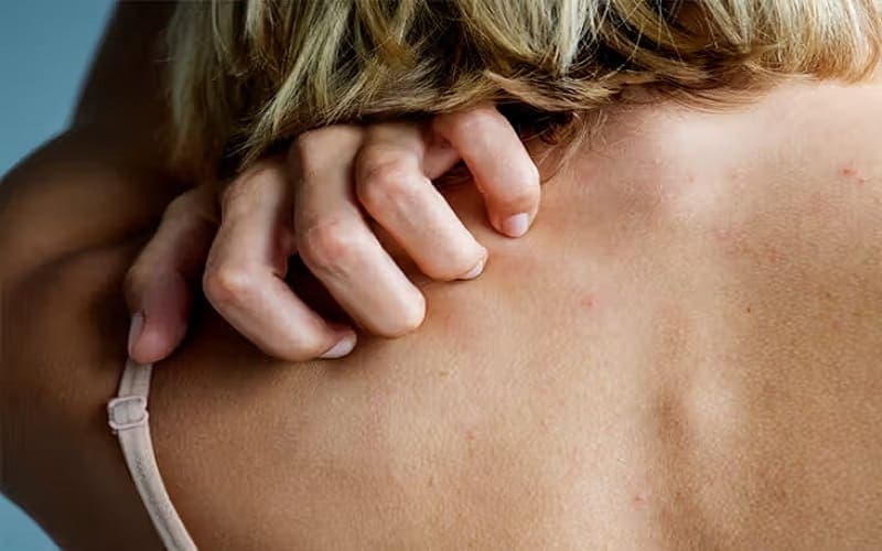 phụ nữ sau sinh nổi mề đay