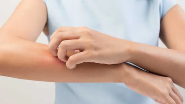 Phác đồ điều trị viêm da tiếp xúc dị ứng