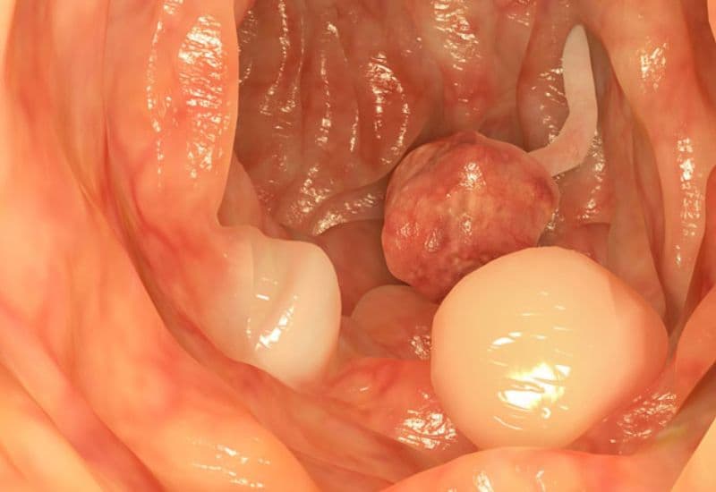 polyp đại tràng bao lâu thành ung thư