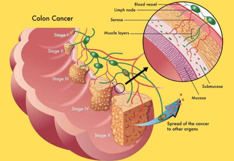 polyp đại tràng bao lâu thành ung thư