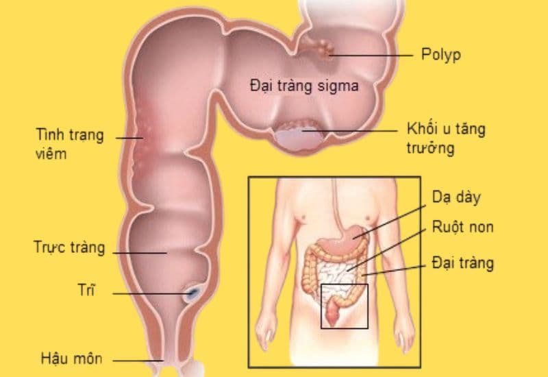 polyp đại tràng sigma 8mm