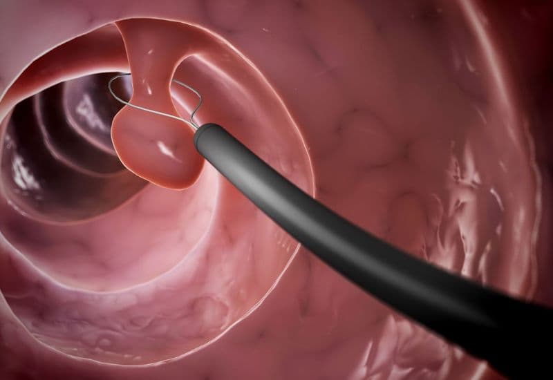 polyp đại tràng sigma 8mm