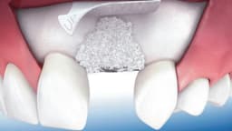 Răng bị tiêu xương có phục hồi được không?