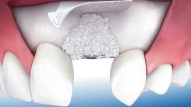 Răng bị tiêu xương có phục hồi được không?