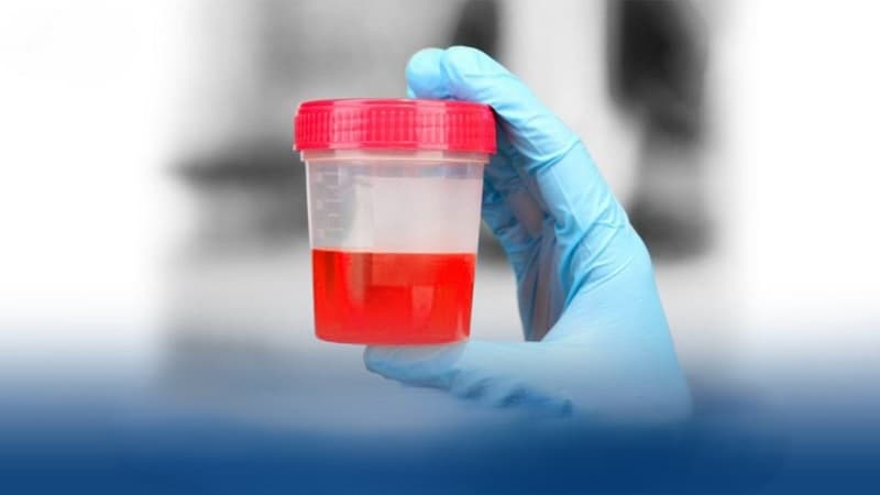 đi tiểu nhiều có phải suy thận không