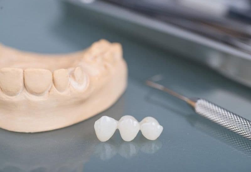 tác hại của cầu răng sứ