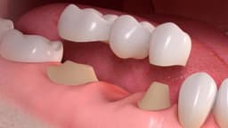 Các tác hại của cầu răng sứ