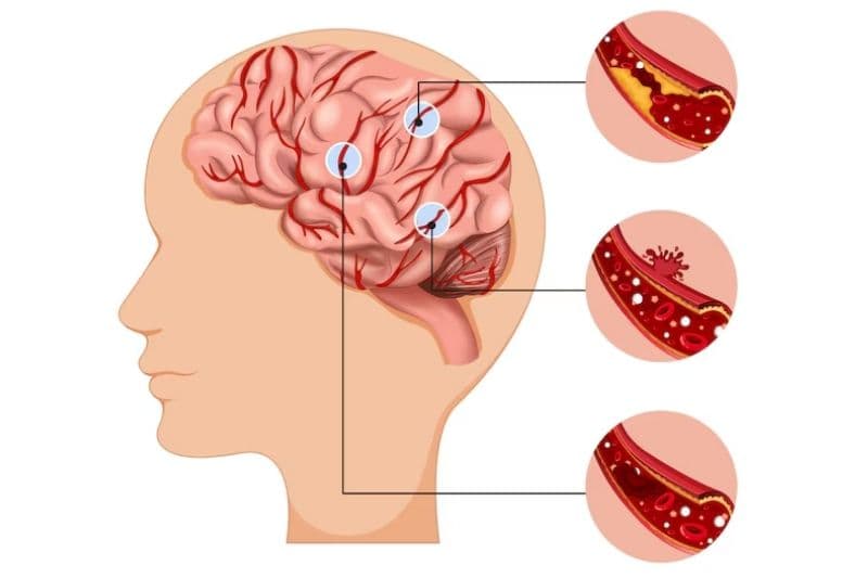 tầm soát đột quỵ cần làm những gì