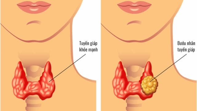 Trẻ em bị nhân tuyến giáp có nguy hiểm không?
