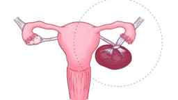Giải đáp vấn đề u nang buồng trứng xoắn có nguy hiểm không