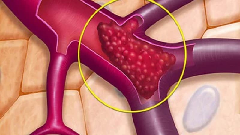 tiêu sợi huyết trong thuyên tắc phổi