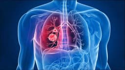 Chỉ định tiêu sợi huyết trong thuyên tắc phổi