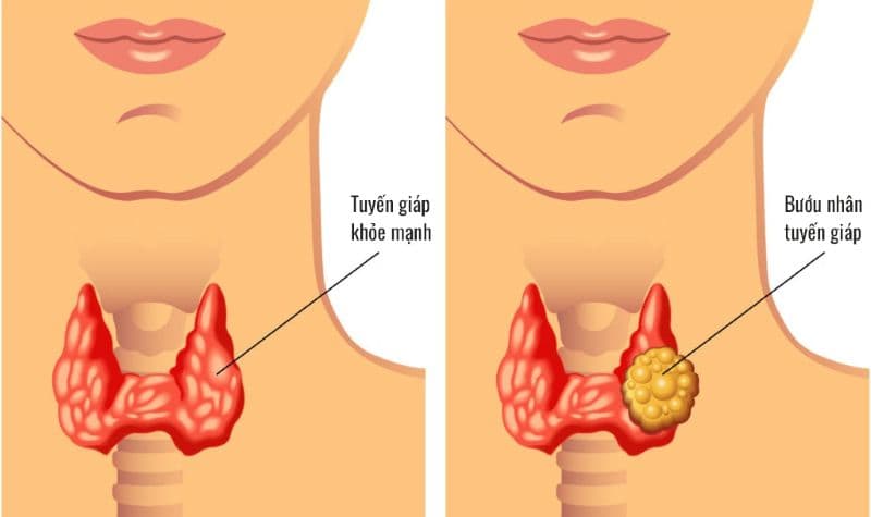 trẻ em bị nhân tuyến giáp có nguy hiểm không