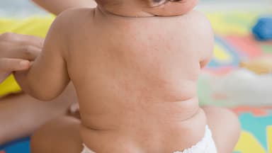 Trẻ em bị phát ban nhưng không sốt, vì sao?