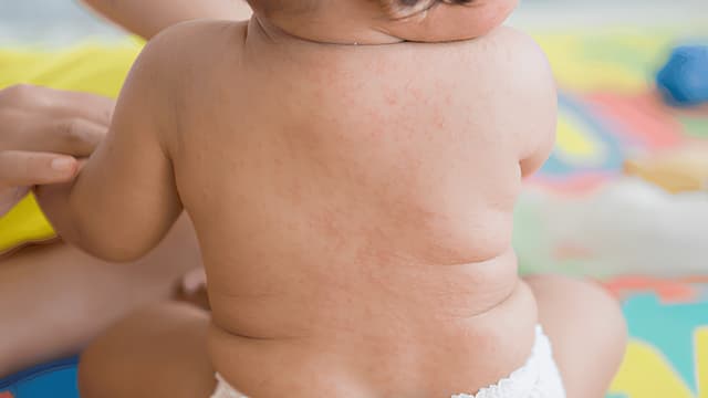 Trẻ em bị phát ban nhưng không sốt, vì sao?