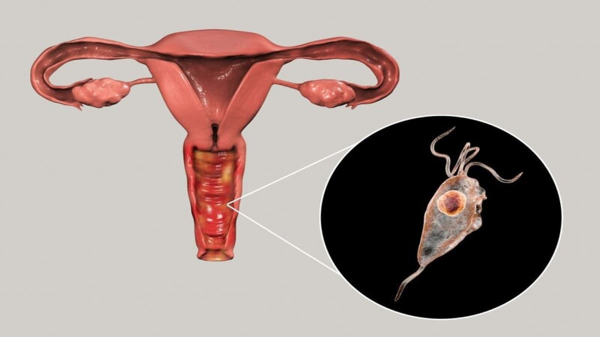 Trichomonas vagіnalis gây bệnh gì?