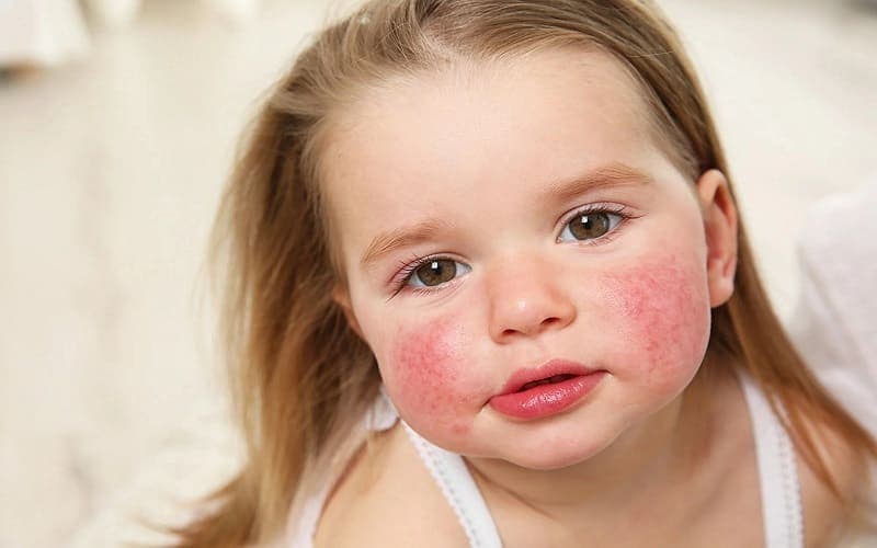 bé dị ứng đạm bò ăn cá hồi được không