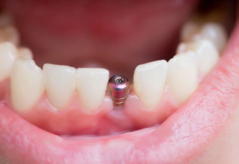 trồng răng implant bao lâu thì ăn được