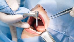 Trồng răng implant bao lâu thì ăn được?