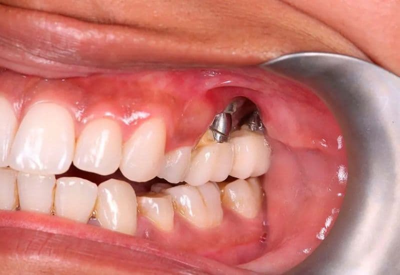 trồng răng implant bị tiêu xương