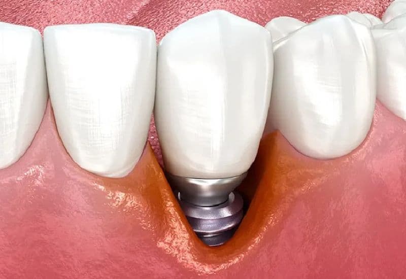 trồng răng implant bị tiêu xương
