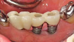 Trồng răng implant bị tiêu xương không?