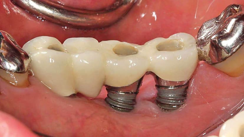 Trồng răng implant bị tiêu xương không?