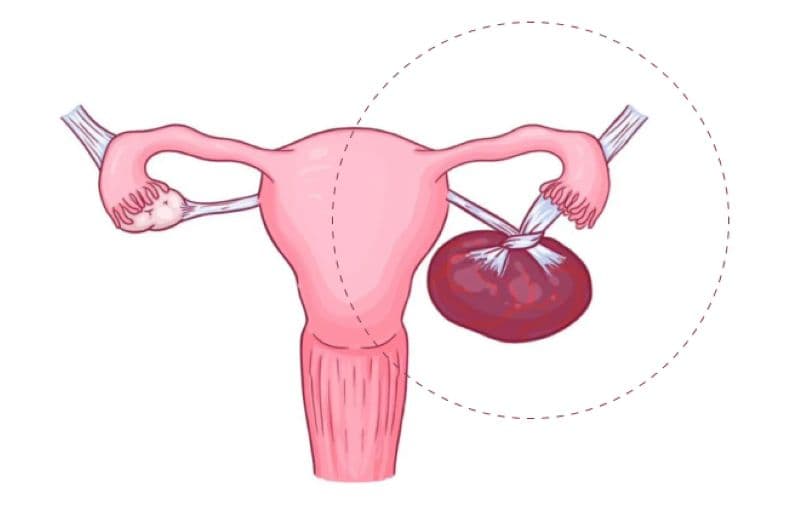 u nang buồng trứng xoắn có nguy hiểm không