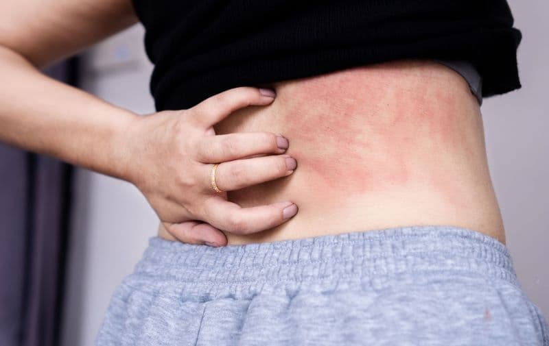 uống rượu bị dị ứng mẩn đỏ